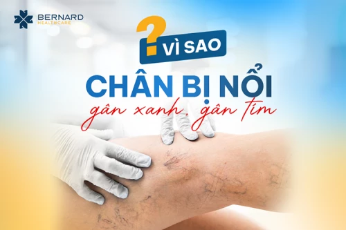 VÌ SAO CHÂN NỔI GÂN XANH, TÍM?